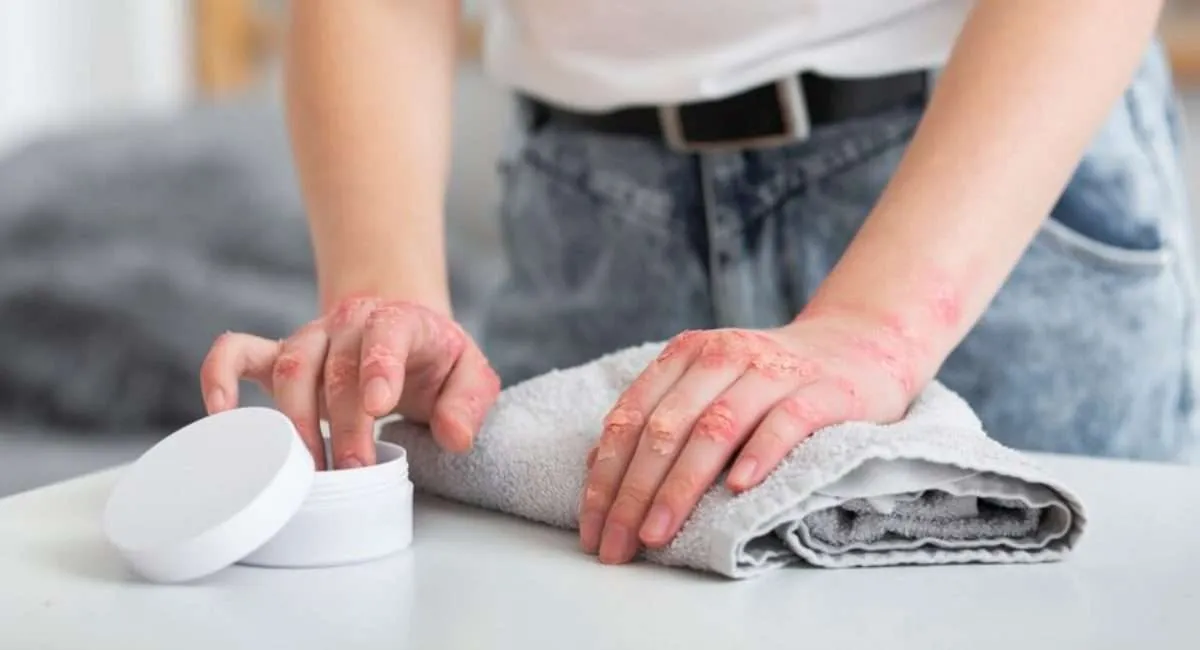 crema para la psoriasis