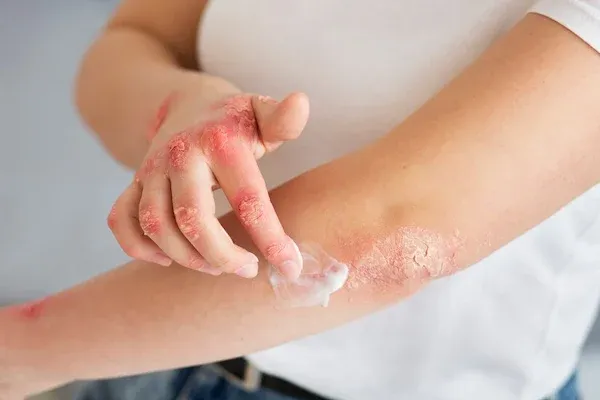 mejor crema para la psoriasis